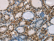 The image on the left is immunohistochemistry of paraffin-embedded Human thyroid cancer tissue using CSB-PA113088(RUNX1T1 Antibody) at dilution 1/35, on the right is treated with synthetic peptide. (Original magnification: ×200)