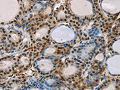 The image on the left is immunohistochemistry of paraffin-embedded Human thyroid cancer tissue using CSB-PA113088(RUNX1T1 Antibody) at dilution 1/35, on the right is treated with synthetic peptide. (Original magnification: ×200)