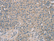 The image on the left is immunohistochemistry of paraffin-embedded Human breast cancer tissue using CSB-PA113101(ROBO2 Antibody) at dilution 1/30, on the right is treated with synthetic peptide. (Original magnification: ×200)