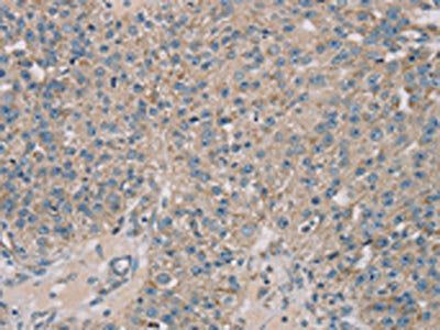 The image on the left is immunohistochemistry of paraffin-embedded Human breast cancer tissue using CSB-PA113101(ROBO2 Antibody) at dilution 1/30, on the right is treated with synthetic peptide. (Original magnification: ×200)