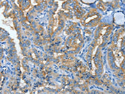 The image on the left is immunohistochemistry of paraffin-embedded Human thyroid cancer tissue using CSB-PA113113(MUC15 Antibody) at dilution 1/50, on the right is treated with fusion protein. (Original magnification: ×200)