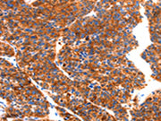 The image on the left is immunohistochemistry of paraffin-embedded Human liver cancer tissue using CSB-PA113302(SEPT4 Antibody) at dilution 1/50, on the right is treated with synthetic peptide. (Original magnification: ×200)