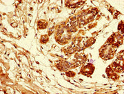 Immunohistochemistry of paraffin-embedded human breast cancer using CSB-PA11339A0Rb at dilution of 1:100
