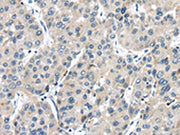 The image on the left is immunohistochemistry of paraffin-embedded Human liver cancer tissue using CSB-PA113579(TRPM2 Antibody) at dilution 1/25, on the right is treated with fusion protein. (Original magnification: ×200)