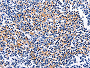 The image on the left is immunohistochemistry of paraffin-embedded Human tonsil tissue using CSB-PA113726(CUL5 Antibody) at dilution 1/10, on the right is treated with fusion protein. (Original magnification: ×200)