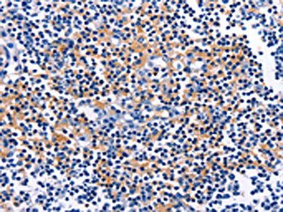 The image on the left is immunohistochemistry of paraffin-embedded Human tonsil tissue using CSB-PA113726(CUL5 Antibody) at dilution 1/10, on the right is treated with fusion protein. (Original magnification: ×200)