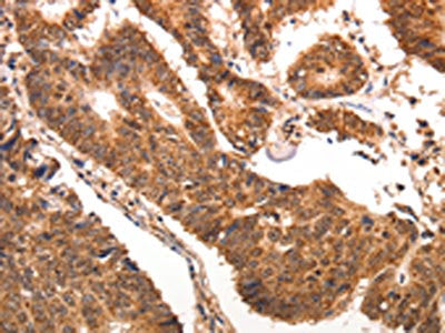 The image is immunohistochemistry of paraffin-embedded human colon cancer tissue using CSB-PA113746(CCL17 Antibody) at dilution 1/70. (Original magnification: ×200)