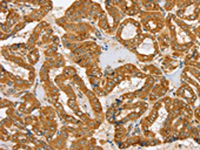 The image on the left is immunohistochemistry of paraffin-embedded Human thyroid cancer tissue using CSB-PA113942(PDP1 Antibody) at dilution 1/30, on the right is treated with fusion protein. (Original magnification: ×200)