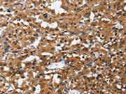 The image on the left is immunohistochemistry of paraffin-embedded Human thyroid cancer tissue using CSB-PA114100(IL2RB Antibody) at dilution 1/60, on the right is treated with fusion protein. (Original magnification: ×200)