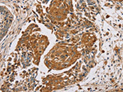 The image on the left is immunohistochemistry of paraffin-embedded Human lung cancer tissue using CSB-PA114224(MUC1 Antibody) at dilution 1/45, on the right is treated with synthetic peptide. (Original magnification: ×200)