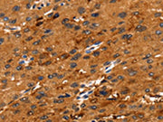The image on the left is immunohistochemistry of paraffin-embedded Human liver cancer tissue using CSB-PA114336(FGFR3 Antibody) at dilution 1/30, on the right is treated with synthetic peptide. (Original magnification: ×200)