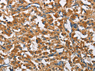 The image on the left is immunohistochemistry of paraffin-embedded Human thyroid cancer tissue using CSB-PA114413(COPB1 Antibody) at dilution 1/50, on the right is treated with fusion protein. (Original magnification: ×200)