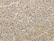 The image on the left is immunohistochemistry of paraffin-embedded Human liver cancer tissue using CSB-PA114461(AFF2 Antibody) at dilution 1/25, on the right is treated with synthetic peptide. (Original magnification: ×200)