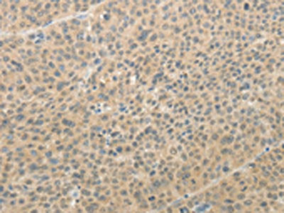 The image on the left is immunohistochemistry of paraffin-embedded Human liver cancer tissue using CSB-PA114461(AFF2 Antibody) at dilution 1/25, on the right is treated with synthetic peptide. (Original magnification: ×200)