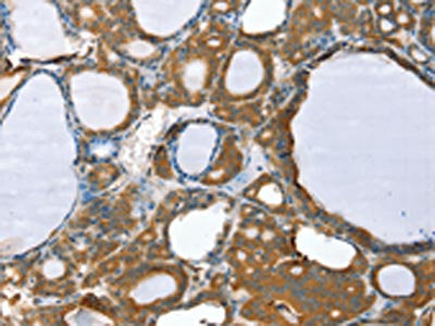 The image on the left is immunohistochemistry of paraffin-embedded Human thyroid cancer tissue using CSB-PA114505(PPP2CA Antibody) at dilution 1/35, on the right is treated with fusion protein. (Original magnification: ×200)