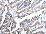 The image on the left is immunohistochemistry of paraffin-embedded Human esophagus cancer tissue using CSB-PA114619(XKR4 Antibody) at dilution 1/25, on the right is treated with synthetic peptide. (Original magnification: ×200)