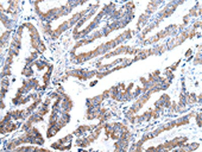 The image on the left is immunohistochemistry of paraffin-embedded Human esophagus cancer tissue using CSB-PA114619(XKR4 Antibody) at dilution 1/25, on the right is treated with synthetic peptide. (Original magnification: ×200)