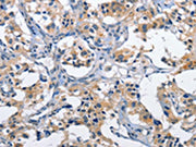 The image on the left is immunohistochemistry of paraffin-embedded Human thyroid cancer tissue using CSB-PA114834(CLEC2D Antibody) at dilution 1/60, on the right is treated with fusion protein. (Original magnification: ×200)