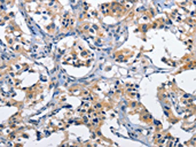 The image on the left is immunohistochemistry of paraffin-embedded Human thyroid cancer tissue using CSB-PA114834(CLEC2D Antibody) at dilution 1/60, on the right is treated with fusion protein. (Original magnification: ×200)