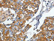 The image on the left is immunohistochemistry of paraffin-embedded Human breast cancer tissue using CSB-PA114925(DPYSL5 Antibody) at dilution 1/10, on the right is treated with synthetic peptide. (Original magnification: ×200)