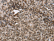 The image on the left is immunohistochemistry of paraffin-embedded Human ovarian cancer tissue using CSB-PA114928(ACVR1B Antibody) at dilution 1/25, on the right is treated with fusion protein. (Original magnification: ×200)