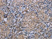 The image on the left is immunohistochemistry of paraffin-embedded Human thyroid cancer tissue using CSB-PA114938(CDC16 Antibody) at dilution 1/50, on the right is treated with synthetic peptide. (Original magnification: ×200)