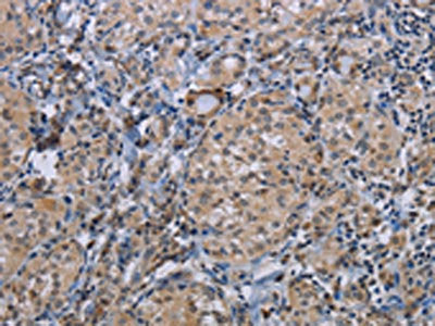 The image on the left is immunohistochemistry of paraffin-embedded Human thyroid cancer tissue using CSB-PA114938(CDC16 Antibody) at dilution 1/50, on the right is treated with synthetic peptide. (Original magnification: ×200)