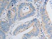 The image on the left is immunohistochemistry of paraffin-embedded Human colon cancer tissue using CSB-PA114989(PDX1 Antibody) at dilution 1/30, on the right is treated with synthetic peptide. (Original magnification: ×200)