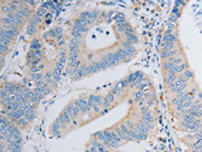 The image on the left is immunohistochemistry of paraffin-embedded Human colon cancer tissue using CSB-PA114989(PDX1 Antibody) at dilution 1/30, on the right is treated with synthetic peptide. (Original magnification: ×200)