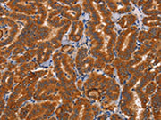 The image on the left is immunohistochemistry of paraffin-embedded Human thyroid cancer tissue using CSB-PA115010(CTSC Antibody) at dilution 1/50, on the right is treated with synthetic peptide. (Original magnification: ×200)