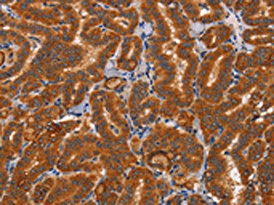 The image on the left is immunohistochemistry of paraffin-embedded Human thyroid cancer tissue using CSB-PA115010(CTSC Antibody) at dilution 1/50, on the right is treated with synthetic peptide. (Original magnification: ×200)