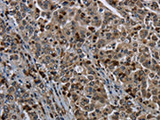 The image on the left is immunohistochemistry of paraffin-embedded Human liver cancer tissue using CSB-PA115108(GP1BA Antibody) at dilution 1/50, on the right is treated with fusion protein. (Original magnification: ×200)