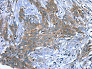 The image on the left is immunohistochemistry of paraffin-embedded Human cervical cancer tissue using CSB-PA115388(SCPEP1 Antibody) at dilution 1/30, on the right is treated with fusion protein. (Original magnification: ×200)