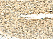 The image on the left is immunohistochemistry of paraffin-embedded Human lung cancer tissue using CSB-PA115416(SHPRH Antibody) at dilution 1/45, on the right is treated with fusion protein. (Original magnification: ×200)
