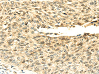 The image on the left is immunohistochemistry of paraffin-embedded Human lung cancer tissue using CSB-PA115416(SHPRH Antibody) at dilution 1/45, on the right is treated with fusion protein. (Original magnification: ×200)
