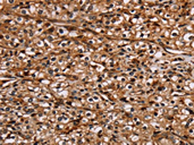 The image on the left is immunohistochemistry of paraffin-embedded Human prostate cancer tissue using CSB-PA115442(NOC2L Antibody) at dilution 1/20, on the right is treated with fusion protein. (Original magnification: ×200)