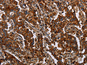The image on the left is immunohistochemistry of paraffin-embedded Human liver cancer tissue using CSB-PA115564(MFSD2A Antibody) at dilution 1/25, on the right is treated with synthetic peptide. (Original magnification: ×200)