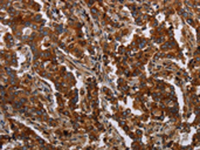 The image on the left is immunohistochemistry of paraffin-embedded Human liver cancer tissue using CSB-PA115564(MFSD2A Antibody) at dilution 1/25, on the right is treated with synthetic peptide. (Original magnification: ×200)