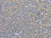 The image on the left is immunohistochemistry of paraffin-embedded Human thyroid cancer tissue using CSB-PA115608(EZR Antibody) at dilution 1/30, on the right is treated with fusion protein. (Original magnification: ×200)
