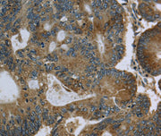 Immunohistochemical analysis of paraffin-embedded Human colon cancer tissue using at dilution 1/60.