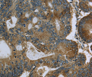 Immunohistochemical analysis of paraffin-embedded Human colon cancer tissue using at dilution 1/60.
