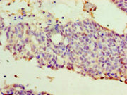 Immunohistochemistry of paraffin-embedded human endometrial cancer using CSB-PA11609A0Rb at dilution of 1:100
