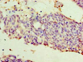 Immunohistochemistry of paraffin-embedded human endometrial cancer using CSB-PA11609A0Rb at dilution of 1:100