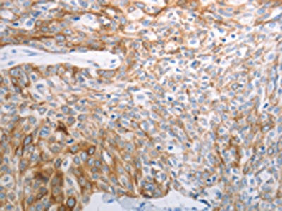 The image on the left is immunohistochemistry of paraffin-embedded Human esophagus cancer tissue using CSB-PA116147(PAK1 Antibody) at dilution 1/25, on the right is treated with synthetic peptide. (Original magnification: ×200)