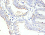 Immunohistochemistry of paraffin-embedded human endometrial cancer using CSB-PA11617A0Rb at dilution of 1:100