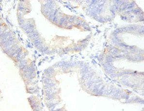 Immunohistochemistry of paraffin-embedded human endometrial cancer using CSB-PA11617A0Rb at dilution of 1:100