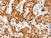 The image on the left is immunohistochemistry of paraffin-embedded Human lung cancer tissue using CSB-PA116412(GRM4 Antibody) at dilution 1/20, on the right is treated with synthetic peptide. (Original magnification: ×200)