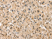 The image on the left is immunohistochemistry of paraffin-embedded Human liver cancer tissue using CSB-PA116429(PSMB8 Antibody) at dilution 1/30, on the right is treated with synthetic peptide. (Original magnification: ×200)