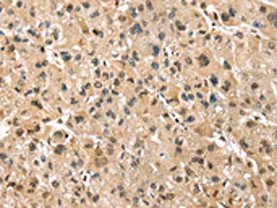 The image on the left is immunohistochemistry of paraffin-embedded Human liver cancer tissue using CSB-PA116429(PSMB8 Antibody) at dilution 1/30, on the right is treated with synthetic peptide. (Original magnification: ×200)
