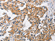 The image on the left is immunohistochemistry of paraffin-embedded Human thyroid cancer tissue using CSB-PA116460(CHMP1A Antibody) at dilution 1/60, on the right is treated with fusion protein. (Original magnification: ×200)